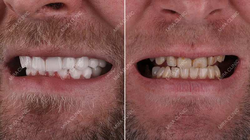 Full-Mouth Approach